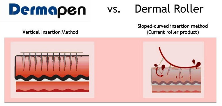 Comparação Dermapen e Dermaroller